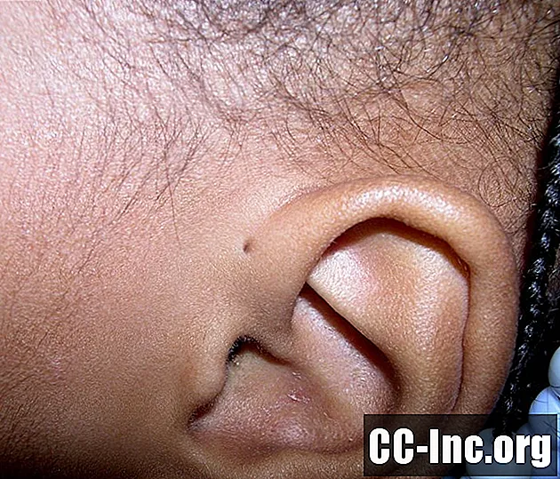 Preaurikulinės duobutės ir skylė jūsų vaiko ausyje