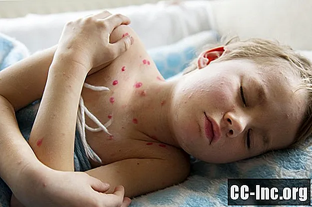 Forekomsten av immunkompromitterte barn