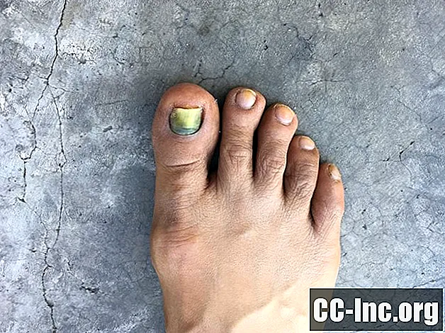 化学療法による足の爪の障害の予防と治療