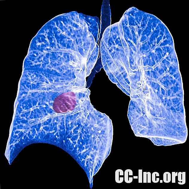Pierwotny i wtórny rak płuca