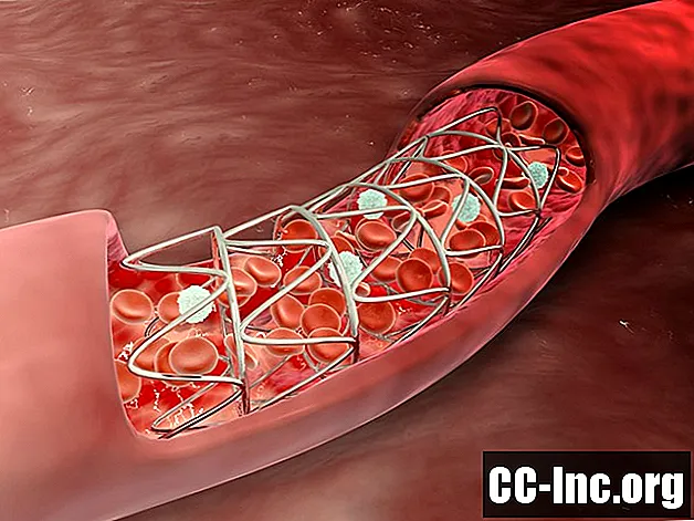 Koronarinės arterijos užsikimšimo stentai