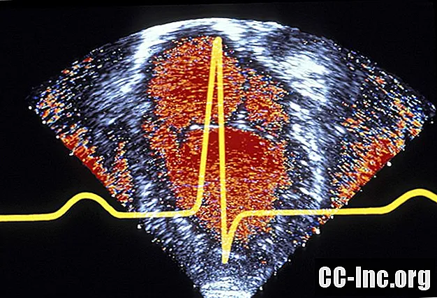 Uma visão geral da cardiomiopatia ventricular direita arritmogênica