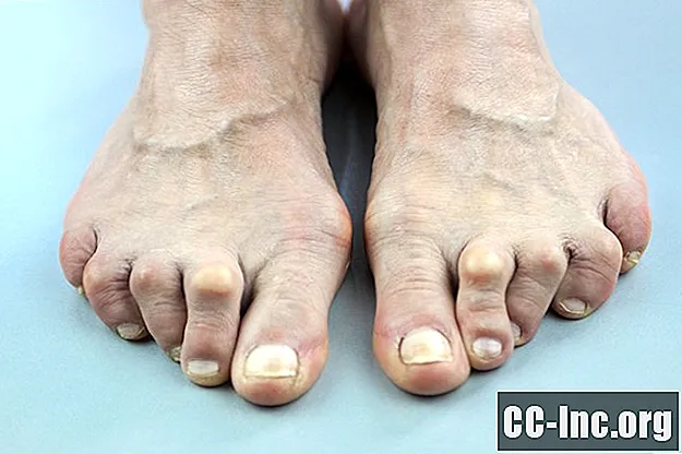 التهاب المفاصل الروماتويدي وتشوه القدم