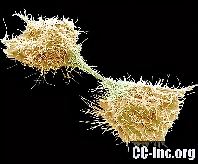 I sarcomi sono tumori maligni del tessuto connettivo