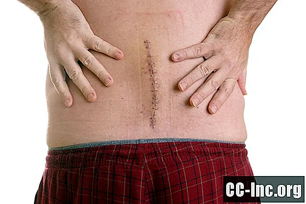 Tecido cicatricial no pescoço e nas costas - Medicamento