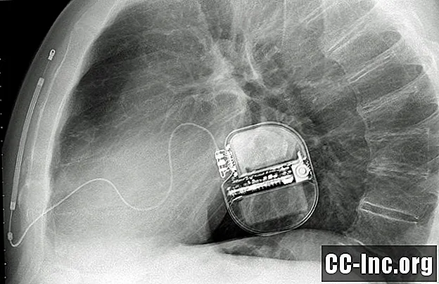 Moet u een implanteerbare defibrillator aanschaffen?