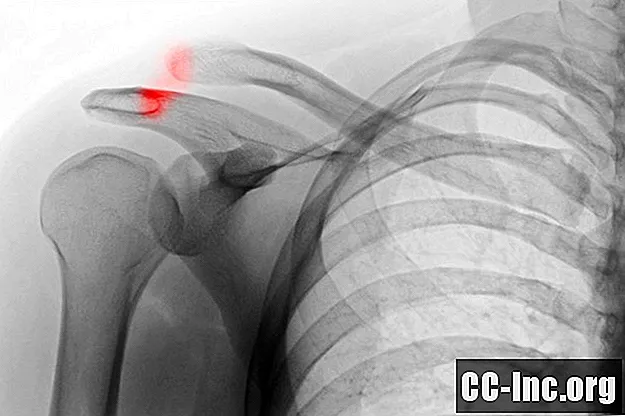 Причины, симптомы и методы лечения расщепления плеч