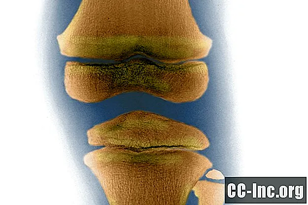 Semnificația osului subcondral în osteoartrita
