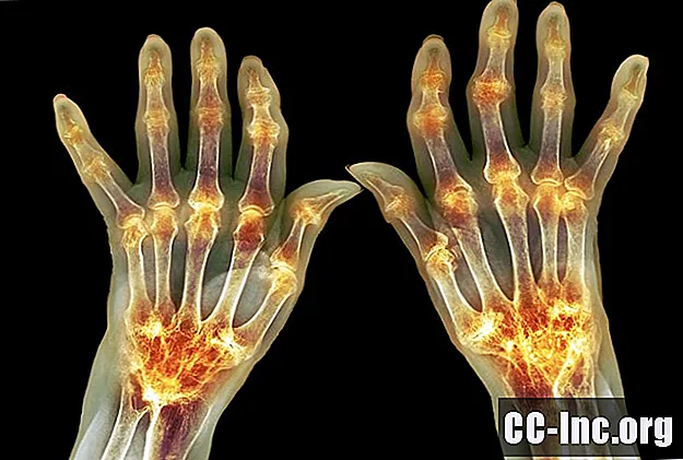 Como Pannus se desenvolve com artrite