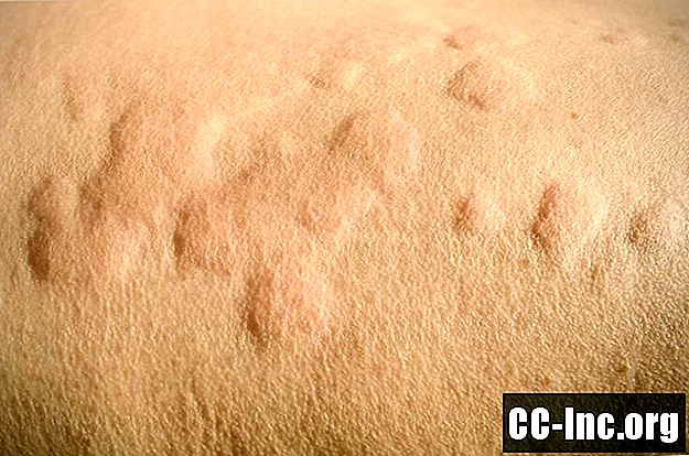 Các vấn đề về da trong bệnh viêm khớp dạng thấp