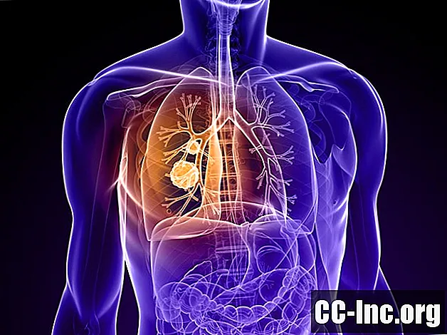 Пушене и рак на белия дроб