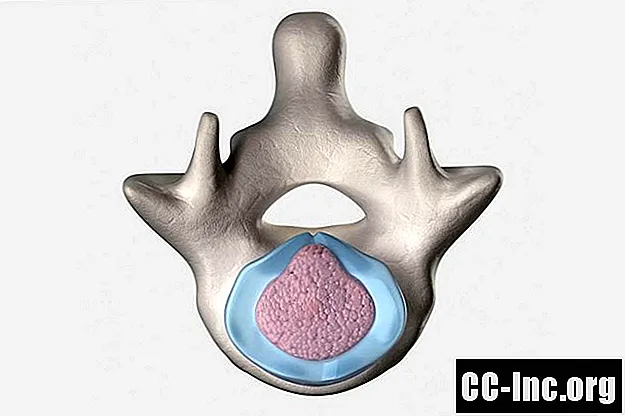 Descripción general de la lesión por hernia de disco espinal
