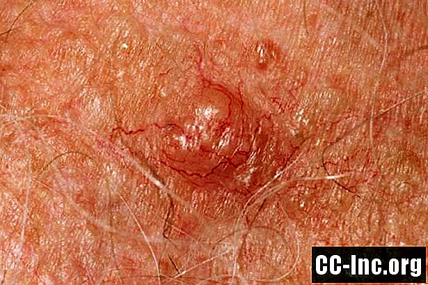 Plakanās un bazālo šūnu karcinomas ķirurģiskās malas