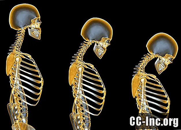 Prednisonin aiheuttama steroidien aiheuttama osteoporoosi