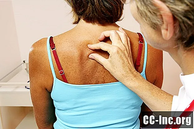 Symtom och tecken på melanom