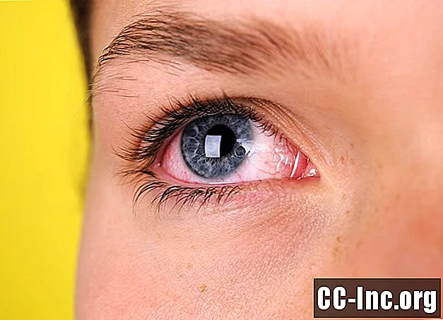 Symptome des rosa Auges (Bindehautentzündung)