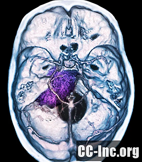 Sintomas de um tumor cerebral