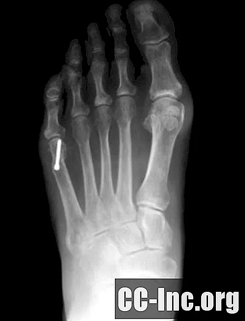 Tailor's Bunion - Bump on the Pinkie Toe Side of the Foot