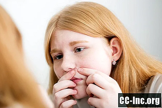 Ajutor pentru adolescenți pentru acnee