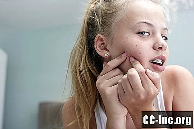 Fatti sull'acne adolescenziale che ogni genitore dovrebbe sapere