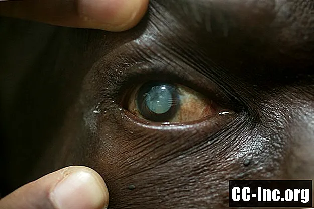 Тестове за диагностициране на катаракта