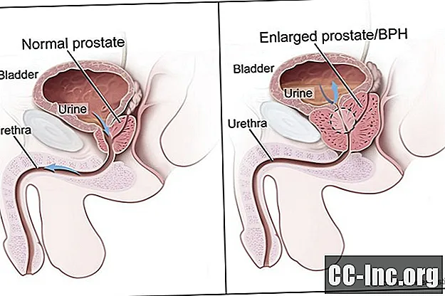 Los 4 problemas de próstata más comunes