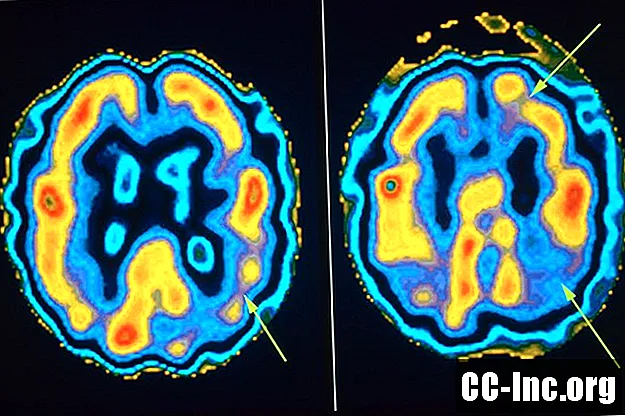 7 giai đoạn và triệu chứng của bệnh Alzheimer