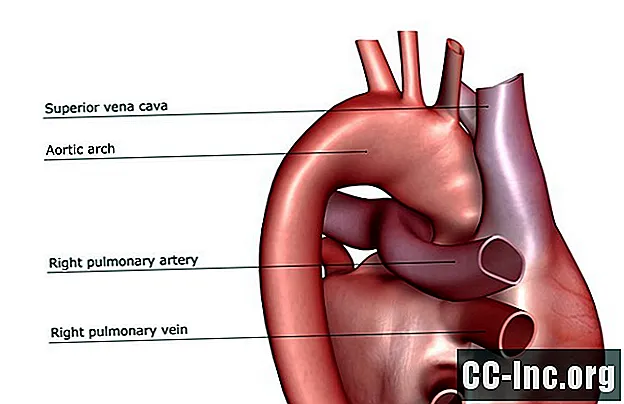 L'anatomie de l'artère pulmonaire