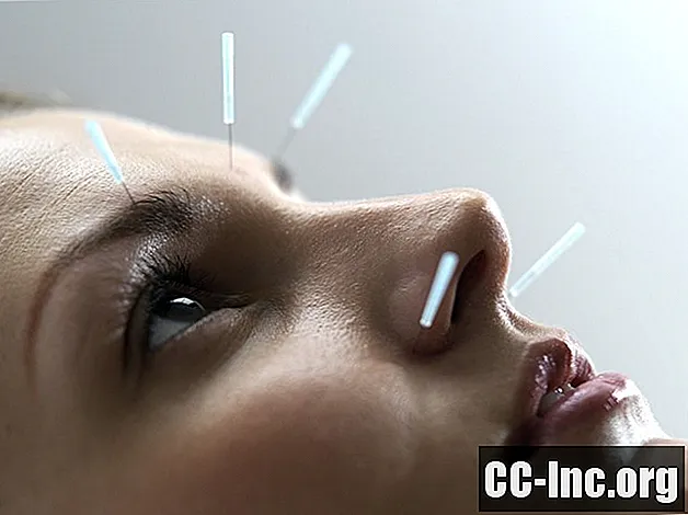 Los beneficios de la acupuntura cosmética