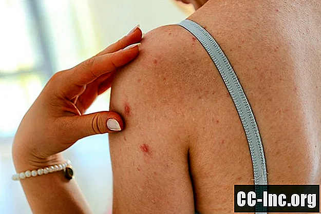 As causas e tratamentos da acne nas costas e no corpo