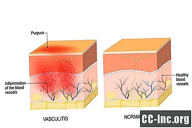 Forbindelsen mellom lupus og vaskulitt