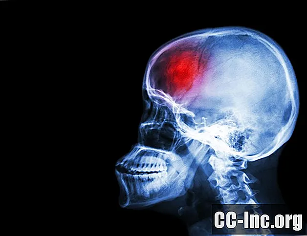 La diferencia entre la parálisis de Bell y el accidente cerebrovascular - Medicamento