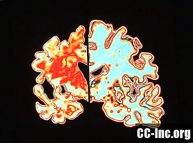 Los efectos del Alzheimer en el cerebro