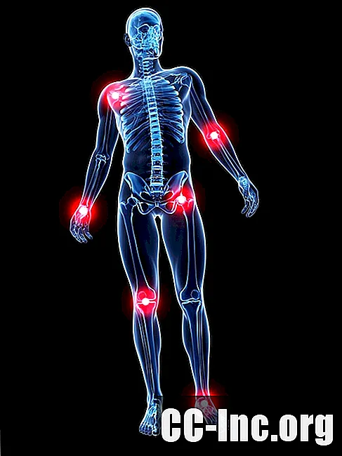 Os efeitos da artrite psoriática em todo o corpo - Medicamento