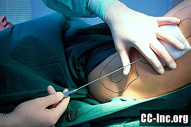 Ameliyat Sonrası Liposuction Bakımı