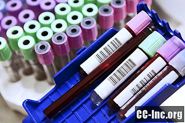 LDH-testen for melanom og påvisning av metastase