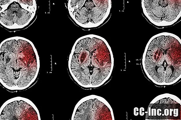 Le lien entre coronavirus et accident vasculaire cérébral