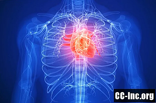Povezava med revmatoidnim artritisom in srčnimi boleznimi