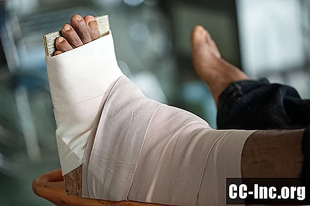 Os prós e contras da cirurgia de fusão do tornozelo - Medicamento