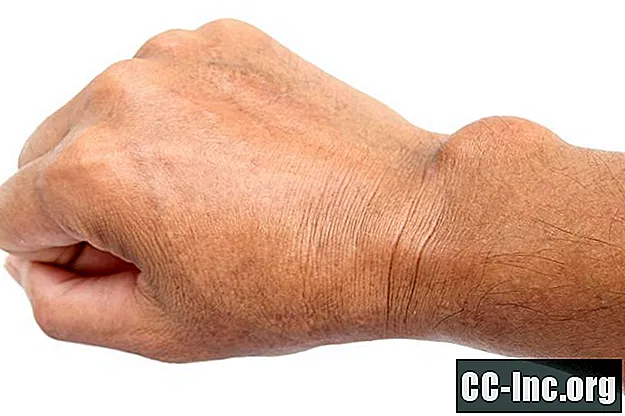 손 종양의 증상, 유형 및 예후