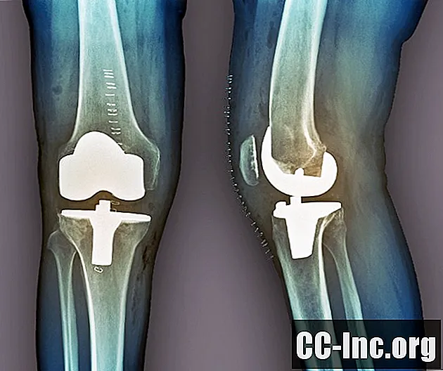 Substituição total vs. parcial do joelho