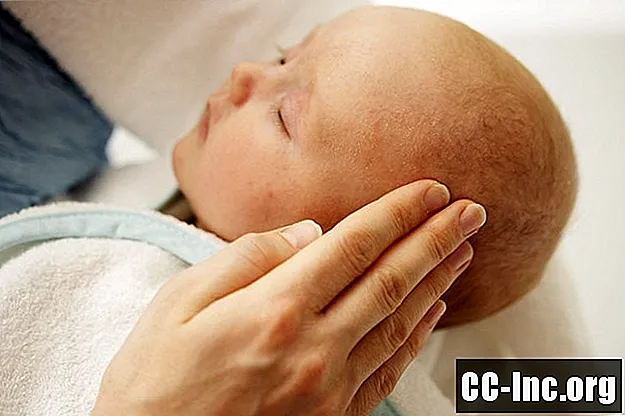 Liječenje osipa na kolijevci kod dojenčadi