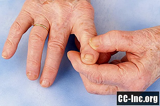 Raccomandazioni per il trattamento dell'osteoartrite della mano