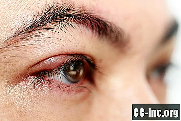 Behandlung und Symptome eines Schweinestalls am Augenlid