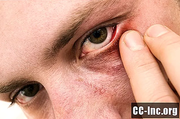 Behandelingen voor oculaire rosacea