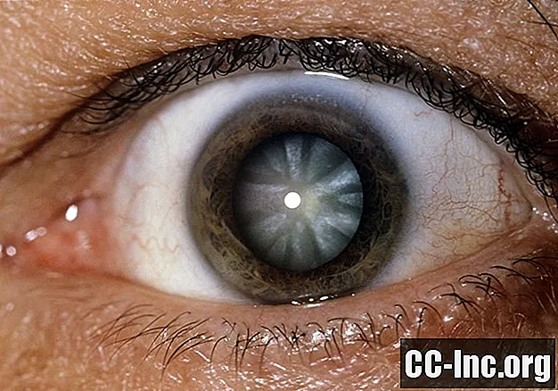 Soorten cataracten