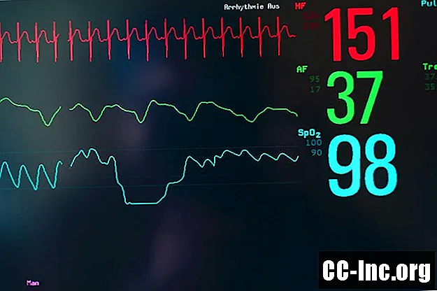 Các loại nhịp tim nhanh trên thất (SVT) - ThuốC