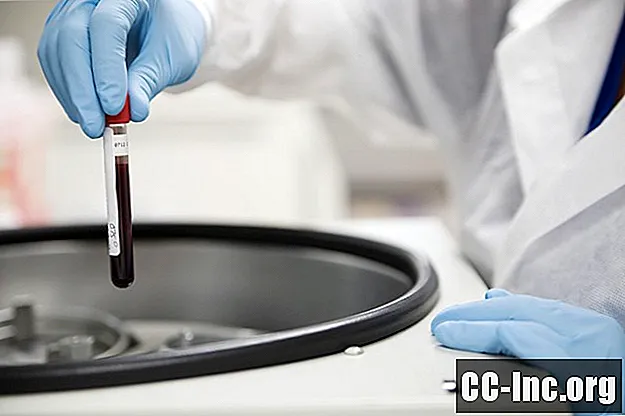 Razumevanje krvnega testa ANA (test antinuklearnih protiteles)