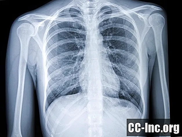Использование рентгена грудной клетки в диагностике рака легких