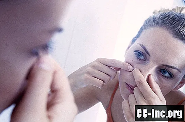 Utilizzo della tetraciclina orale come trattamento per l'acne
